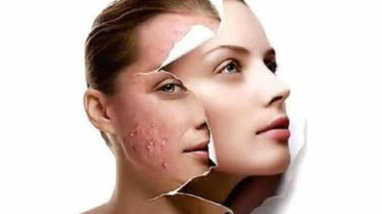 Peelings Químicos Superficiais: Beneficie sua pele sem agredi-la